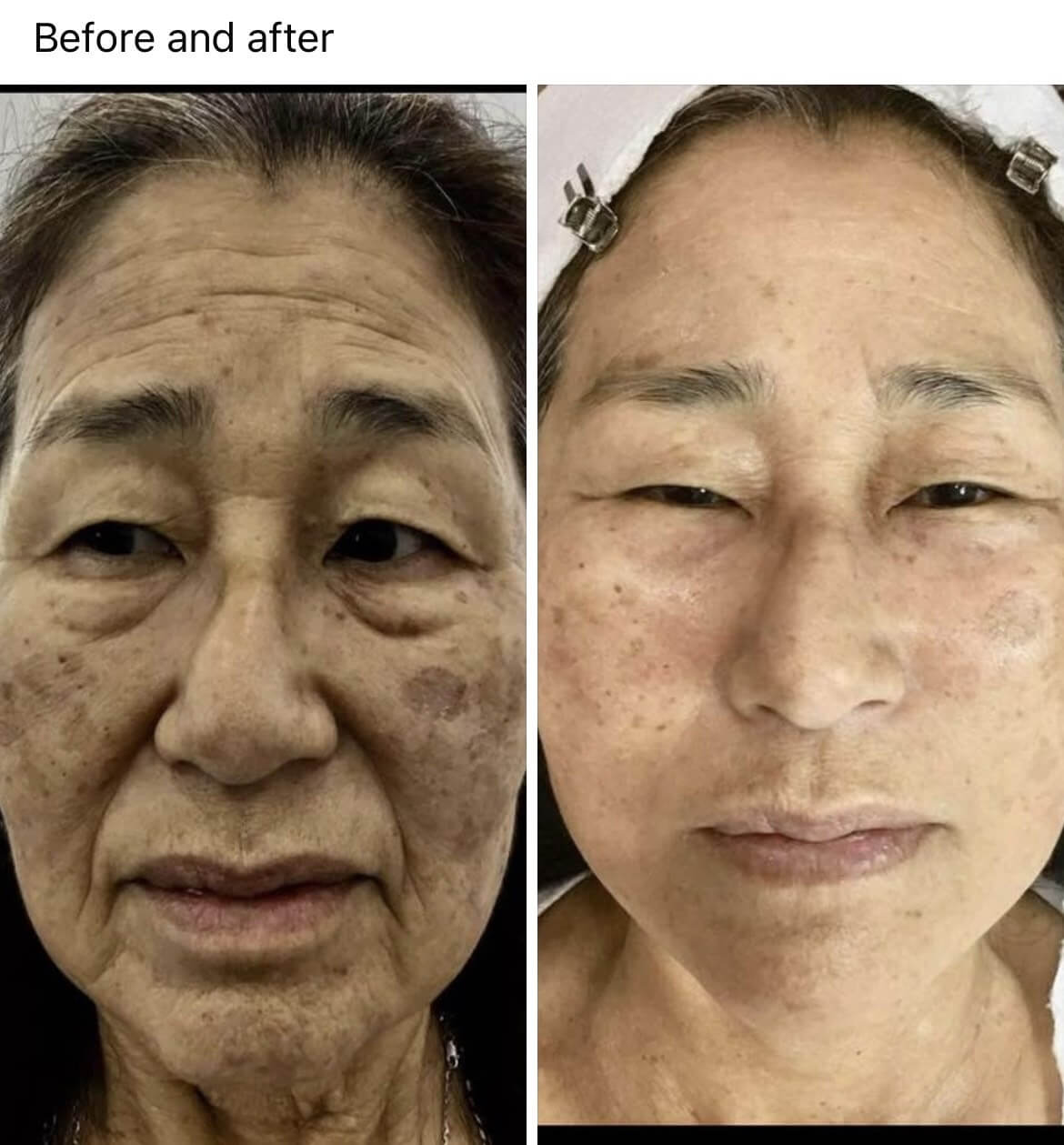 Skin Rejuvenation and Remove Pigmentation by Mesotherapy